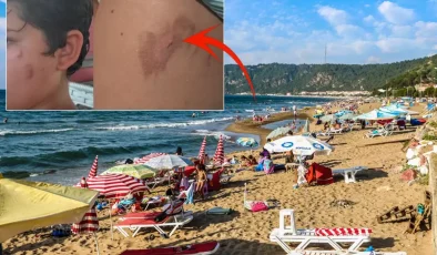 Vatandaşlar tedirgin! Denize giren yanıklarla çıkıyor